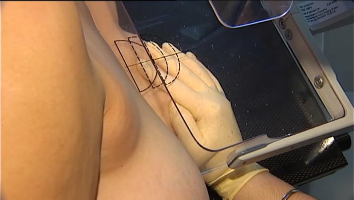 La detección precoz es fundamental en los casos de cáncer de mama