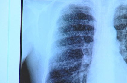 Pulmones afectados por silicosis